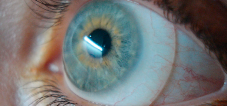 Quanto tempo dura as lentes esclerais? Quanto tempo dura as lentes esclerais?